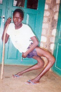 cameroon.glores. Youth with recurvature legs