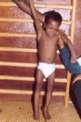 cameroon.glores. Child with legs straightened