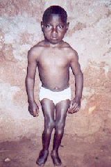 cameroon.glores. Child with legs straightened